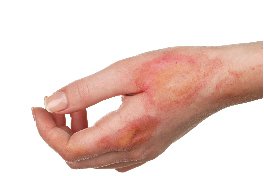 surgical scar removal